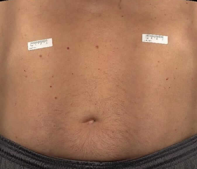 Abdomen of a patient before a HyQvia infusion.
